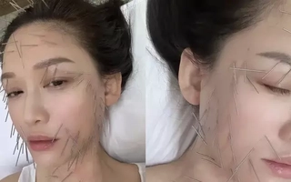 Trần Kiều Ân gây tranh cãi với phương pháp làm đẹp đau đớn