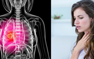 Dấu hiệu ung thư phổi ở nam và nữ khác nhau: Chị em cảnh giác với những biểu hiện "mập mờ"