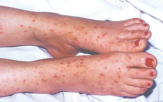 Bệnh viêm màng não mủ do não mô cầu có nguy cơ tái phát