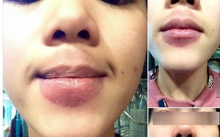 Cám cảnh cô gái môi sưng và thâm xì vì tự làm đẹp với kỹ thuật "bơm môi" bằng... chén