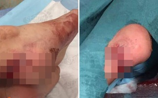 Kẹt thang cuốn, bé gái 2 tuổi bị cứa rách gót chân