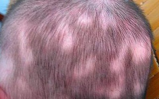 Cậu bé 4 tuổi rụng tóc nghiêm trọng, mẹ phát hoảng khi biết được nguyên nhân