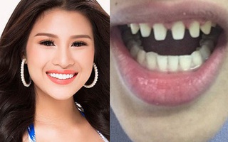 Nếu tháo hết răng sứ, liệu có ai dám nhìn Nguyễn Thị Thành khi cười?