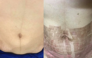 Chi 15 triệu làm đẹp sau sinh ở spa, mẹ trẻ bị bắn laser chín thịt, bụng chi chít sẹo bỏng