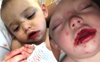 Thêm 1 trường hợp trẻ nhiễm virus Herpes chỉ vì nụ hôn của người lớn