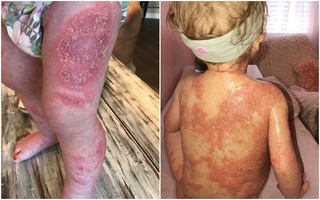 Sinh con ra bình thường, vài ngày sau bà mẹ xót xa nhìn con mắc phải căn bệnh đáng sợ
