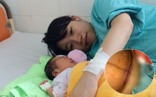 Kiêng cữ quá kĩ sau sinh, bà mẹ trẻ bị nhiễm trùng vết mổ đẻ phải điều trị cả tháng trời
