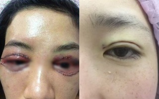 Bác sĩ thẩm mỹ nói về vụ "cắt mí gây bão": có thể sưng và đỏ sau thủ thuật, nhưng về mỹ quan thì hỏng