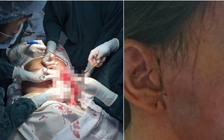 Bơm má, xóa nếp nhăn để đón Tết, một phụ nữ bị nhiễm trùng máu