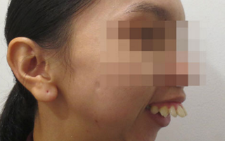 Cô gái “răng chuột” qua 45 lần phẫu thuật, 30 năm không thể ngủ nằm được cứu vớt cuộc đời