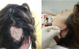 Chị em đi làm tóc cuối năm hãy cẩn thận: đã có người bị lột da đầu, người suýt mất tai