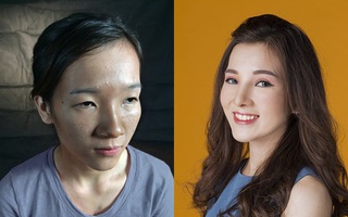 Cô gái "mắt lươn" từng bị ngăn cấm tình yêu, đuổi việc vì "nhìn gian manh" lột xác ngoạn mục sau phẫu thuật thẩm mỹ