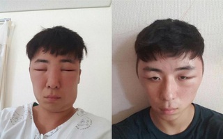 Ham nhuộm tóc giá rẻ, chàng thanh niên nhận lại quả đầu sưng to, mắt không mở được