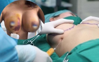 Những hiểm họa sau phẫu thuật nâng ngực khiến ai nhìn cũng khiếp sợ