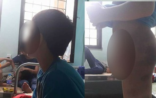 Hà Nội: Một học sinh 13 tuổi nhập viện vì bị hai thầy giáo đánh tím bầm toàn thân