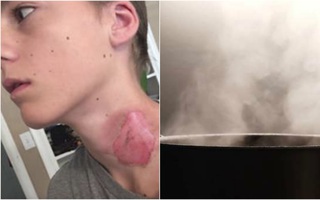 Hết thử thách cá voi xanh, giới trẻ Mỹ lại điên đảo với thử thách nước sôi chết người