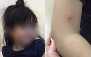 Phụ huynh bức xúc tố cô giáo trường MN quốc tế  đánh con gái 3 tuổi trầy xước khắp người