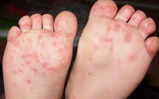 Long An: Bé trai 11 tuổi suýt mất chân vì...kiến cắn