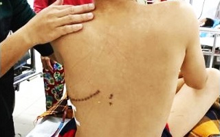 Chọc ghẹo bạn, bé trai 14 tuổi bị phóng kéo vào lưng xuyên thấu ngực