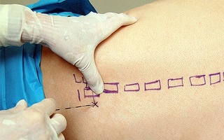 Cần biết: Phân biệt gây tê tủy sống và gây tê ngoài màng cứng