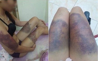 Hà Nội: Một cô gái tố bị bạn trai cũ ghen tuông đánh tím bầm toàn thân