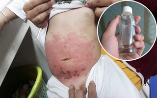Mẹ bôi dầu khuynh diệp trực tiếp lên người con quá nhiều, bé gái 14 tháng tuổi bị bỏng da bụng