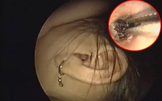 Ngủ trưa, bé gái 9 tuổi bị gián chui vào lỗ tai