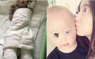 Mẹ cạo đầu, lột da để cứu con trai 2 tuổi bị bỏng nặng vì ngã vào nồi nước sôi