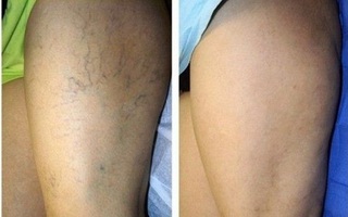 Mẹ tôi chữa khỏi suy giãn tĩnh mạch nhờ massage với thứ này mỗi ngày