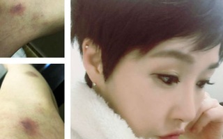 Diễn viên “Tên tôi là Kim Sam Soon” Kim Sun Ah bị thương trên phim trường