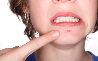 Tuyệt đối tránh nặn những loại mụn này trên da nếu bạn không muốn rước thêm họa vào thân