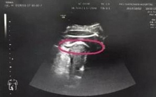 Hy hữu: Thai phụ suýt chết vì đứa bé trong bụng đạp rách tử cung
