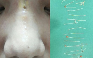 Bị hoại tử sau thủ thuật nâng mũi bằng chỉ, nữ diễn viên xinh đẹp đến bệnh viện cầu cứu các bác sĩ