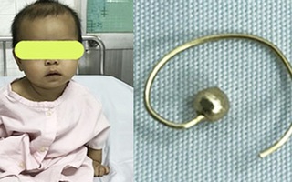 Phụ huynh cẩn trọng: Giật hoa tai của mẹ nuốt vào bụng, bé gái 7 tháng tuổi bị rách thực quản