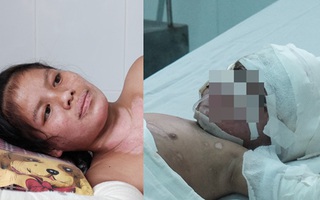 Nến rớt xuống bình xăng dưới giường, hai mẹ con thai phụ bỏng nặng, chồng chưa cưới ôm tiền ủng hộ bỏ trốn