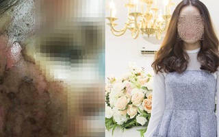 Cô gái “lột da Đông y” bị bỏng nặng và cuộc chiến giữa bác sĩ thẩm mỹ với kem trộn biến tướng