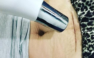 Người phụ nữ dùng máy sấy thổi vào vết mổ sau sinh, hiểu được công dụng này, mẹ nào sinh mổ cũng cần “giắt lưng”