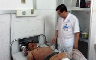 Bếp cồn cháy dữ dội, 11 người đang ăn tiệc cưới bị bỏng