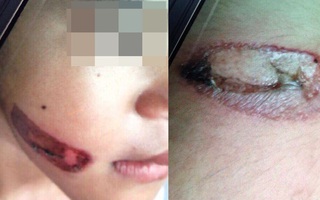 Sự thật vụ bé gái bị cha đẻ và mẹ kế bạo hành dã man