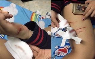 Cô gái trẻ phải điều trị phơi nhiễm HIV khi bị nhóm biến thái rạch đùi trong đêm ở Sài Gòn