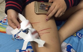 Công an vào cuộc xác minh vụ nữ sinh bị rạch đùi trên đường phố Sài Gòn