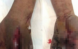 Pin điện thoại dự phòng phát nổ, người đàn ông dập nát bàn tay trái