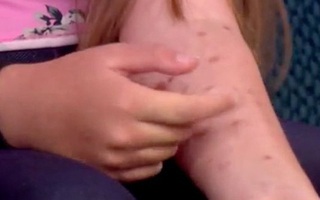 Bé gái tự làm tay mình bị bỏng nặng để đua theo trào lưu ở trường