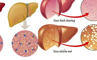15 tuổi đã bị "máu vàng, gan vàng" vì nghiện ăn trứng
