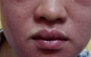 Mặt “biến dạng” vì thần dược siêu trắng da