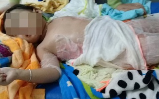 Dự tiệc nhà hàng, bé 3 tuổi bỏng nặng vì ngã vào nồi chè