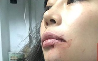 Nữ hành khách bị lái xe Uber đánh "bầm mặt": Tôi cần một lời xin lỗi công khai!