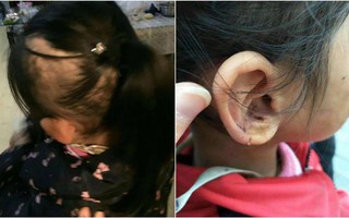 Bé gái 6 tuổi bị mẹ đẻ ngược đãi dã man khiến mặt đầy vết thương, tóc rụng thành mảng lớn