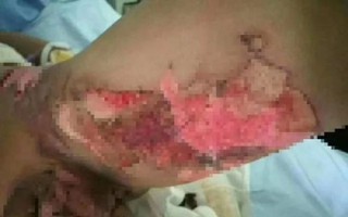 Kinh hoàng: Hai học sinh tiểu học bị bạn cùng lớp dội nước sôi vào người gây nhiễm trùng nghiêm trọng