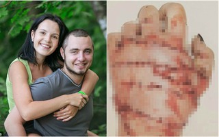 Cuồng ghen tới bệnh hoạn, chồng nhẫn tâm cầm rìu chặt đứt bàn tay vợ